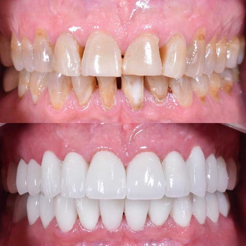 bio-dental-care-tijuana-before-and-after-smile-makeover-6